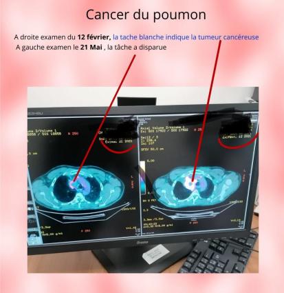 Cancer du poumon de stade 4 par magnétisme