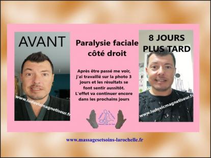 Paralysie faciale par magnetisme a distance
